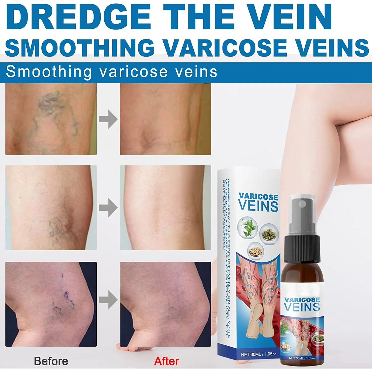 Veinhealing Varicose Veins Treatment Spray